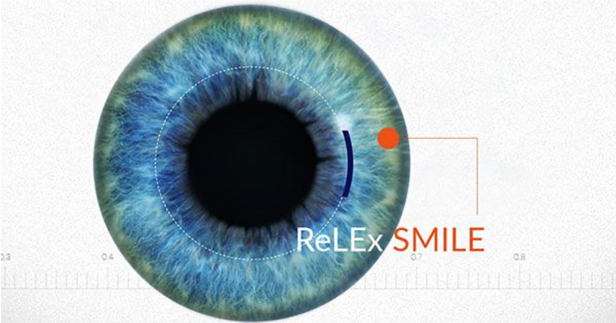 ReLEx SMILE - KỸ THUẬT CHỮA TẬT KHÚC XẠ TIÊN TIẾN NHẤT HIỆN NAY