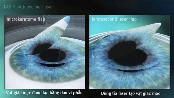 FEMTOSECOND LASER - CHỮA TẬT KHÚC XẠ NHANH - AN TOÀN - HIỆU QUẢ