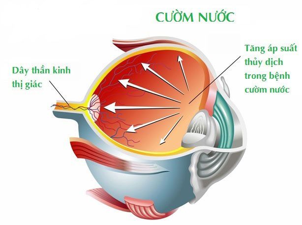 Phẫu thuật cườm nước Glaucoma